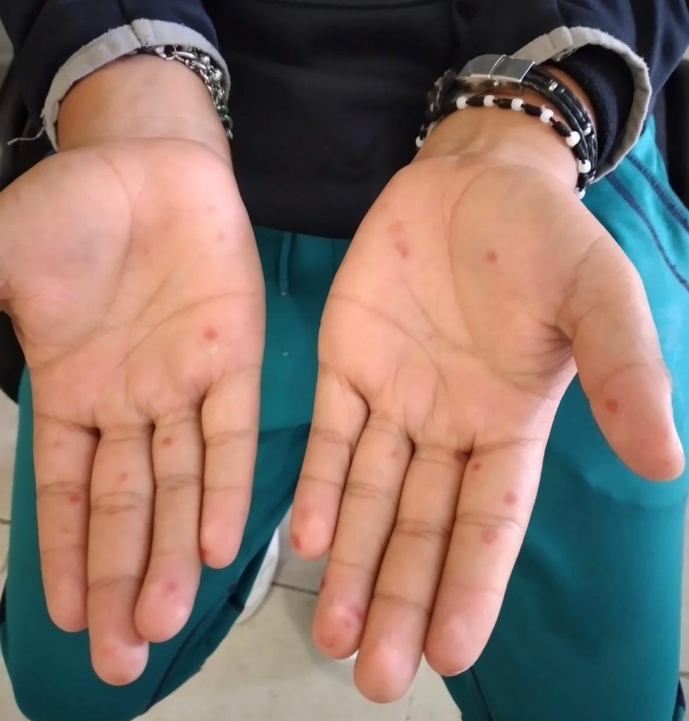 Lanza SSO exhorto a población para reforzar medidas  de higiene y evitar casos de Coxsackie