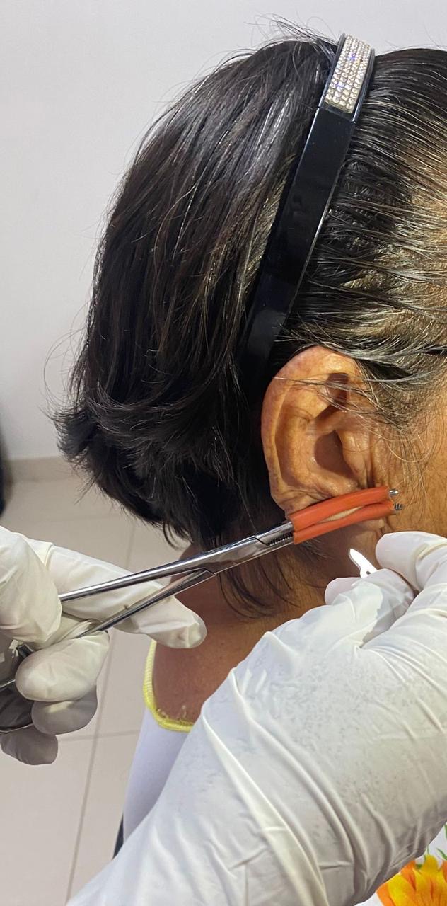 Sin casos nuevos de lepra en Oaxaca