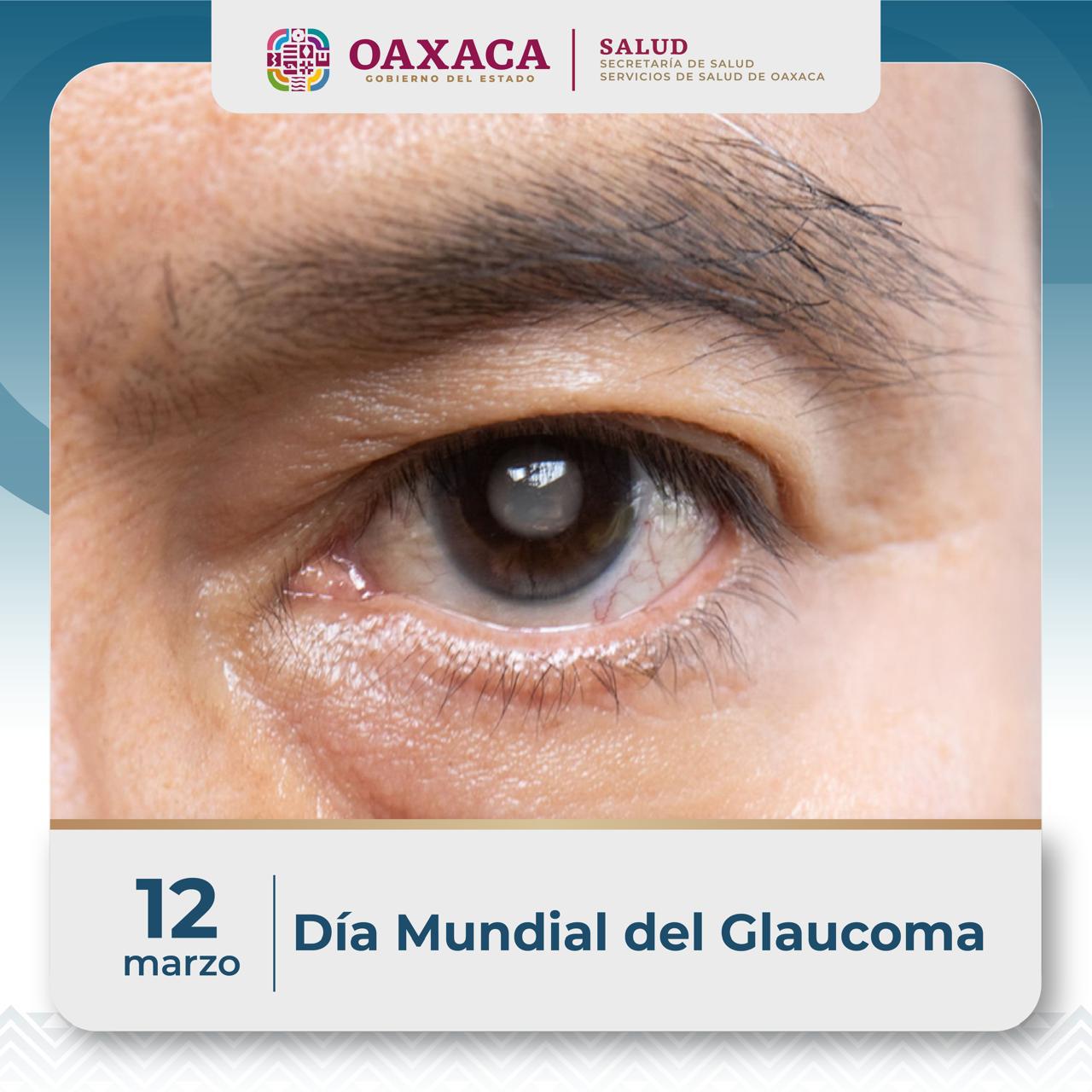 Glaucoma, enemigo silencioso de la visión: SSO