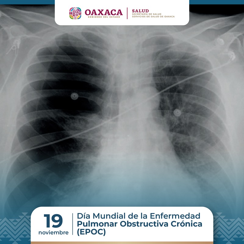 Exhorta SSO a prevenir la Enfermedad Pulmonar Obstructiva Crónica