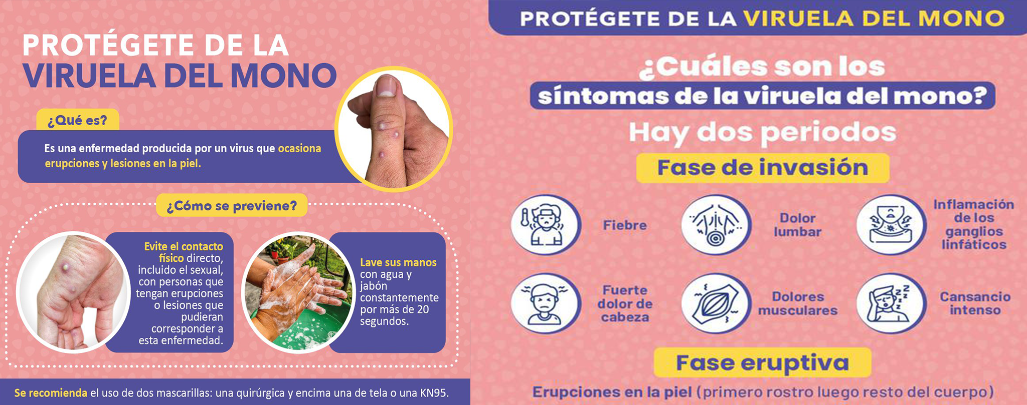 Viruela Símica